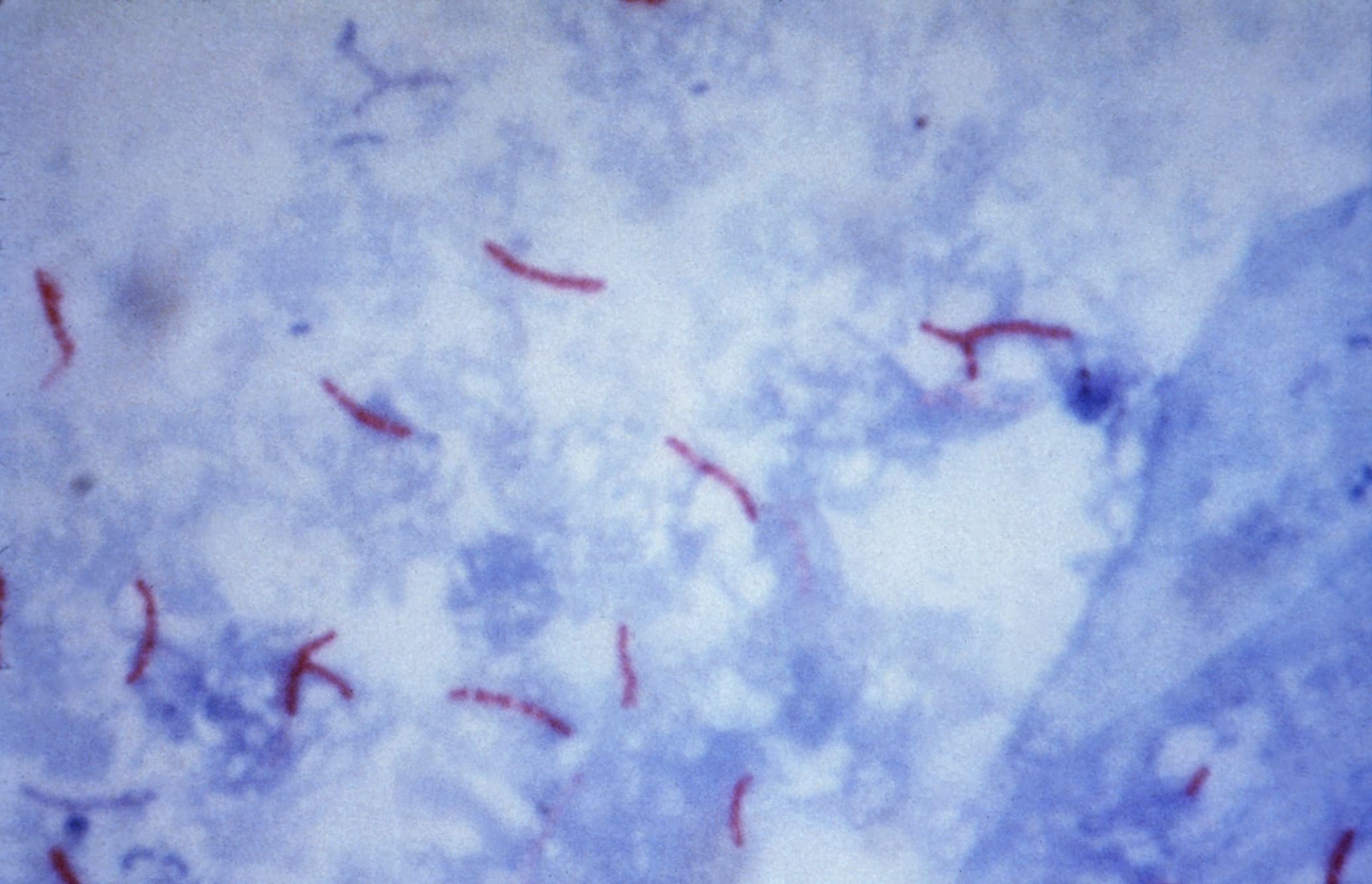 Окраска по Цилю-Нильсену: кислотоустойчивые бактерии Mycobacterium tuberculosis под микроскопом