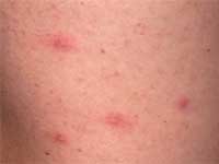 Кожа с везикулёзной сыпью при инфекции Rickettsia australis