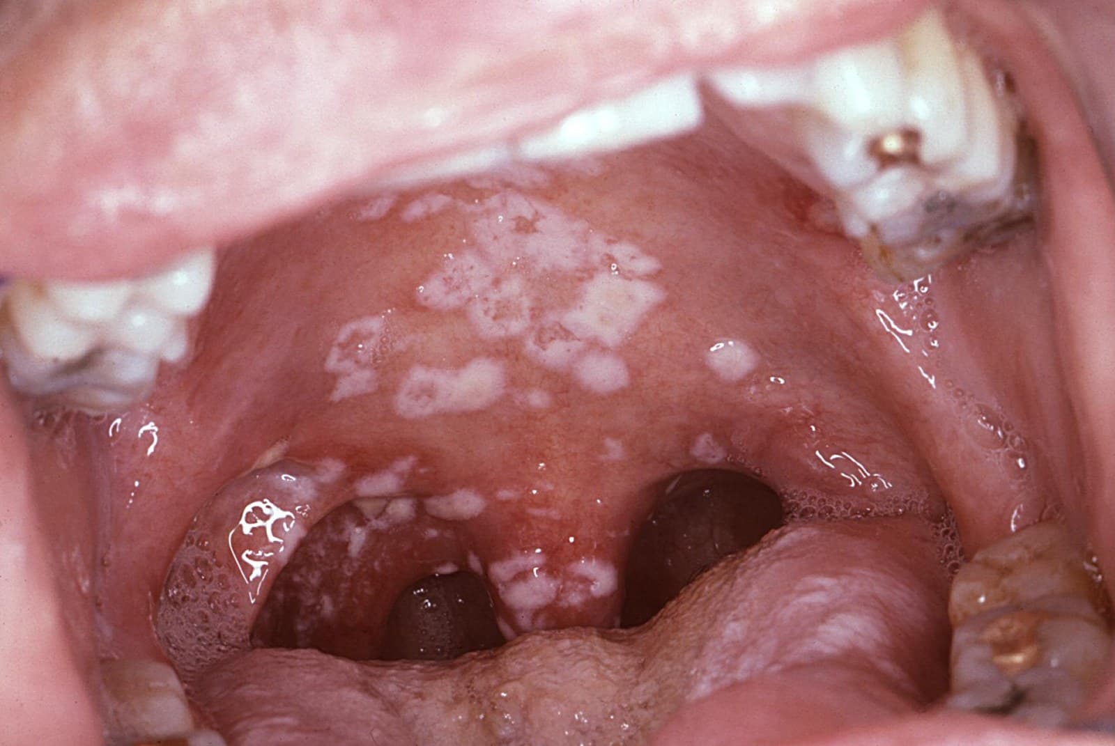 Mucosa oral recoberta por placas brancas destacáveis.