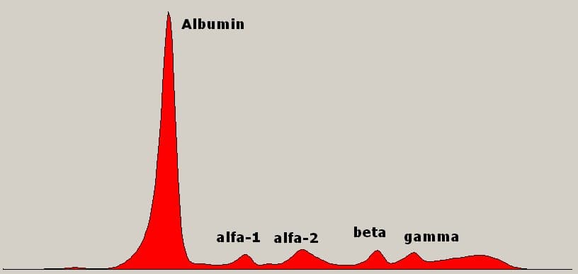 Diagrama da curva de eletroforese de proteínas séricas com albumina, alfa, beta e gama identificadas.