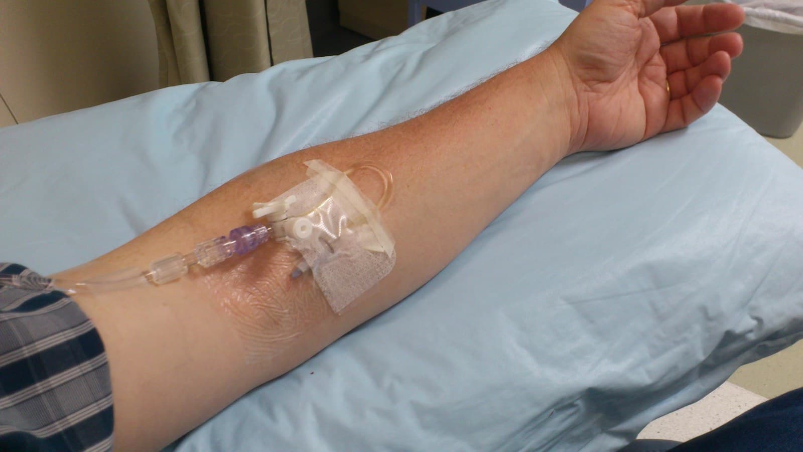 Frasco de imunoglobulina humana conectado a equipo durante infusão.