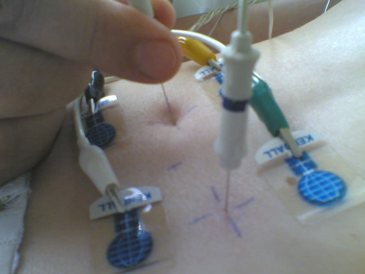 Exame de eletroneuromiografia sendo realizado com eletrodo de agulha na musculatura paravertebral.