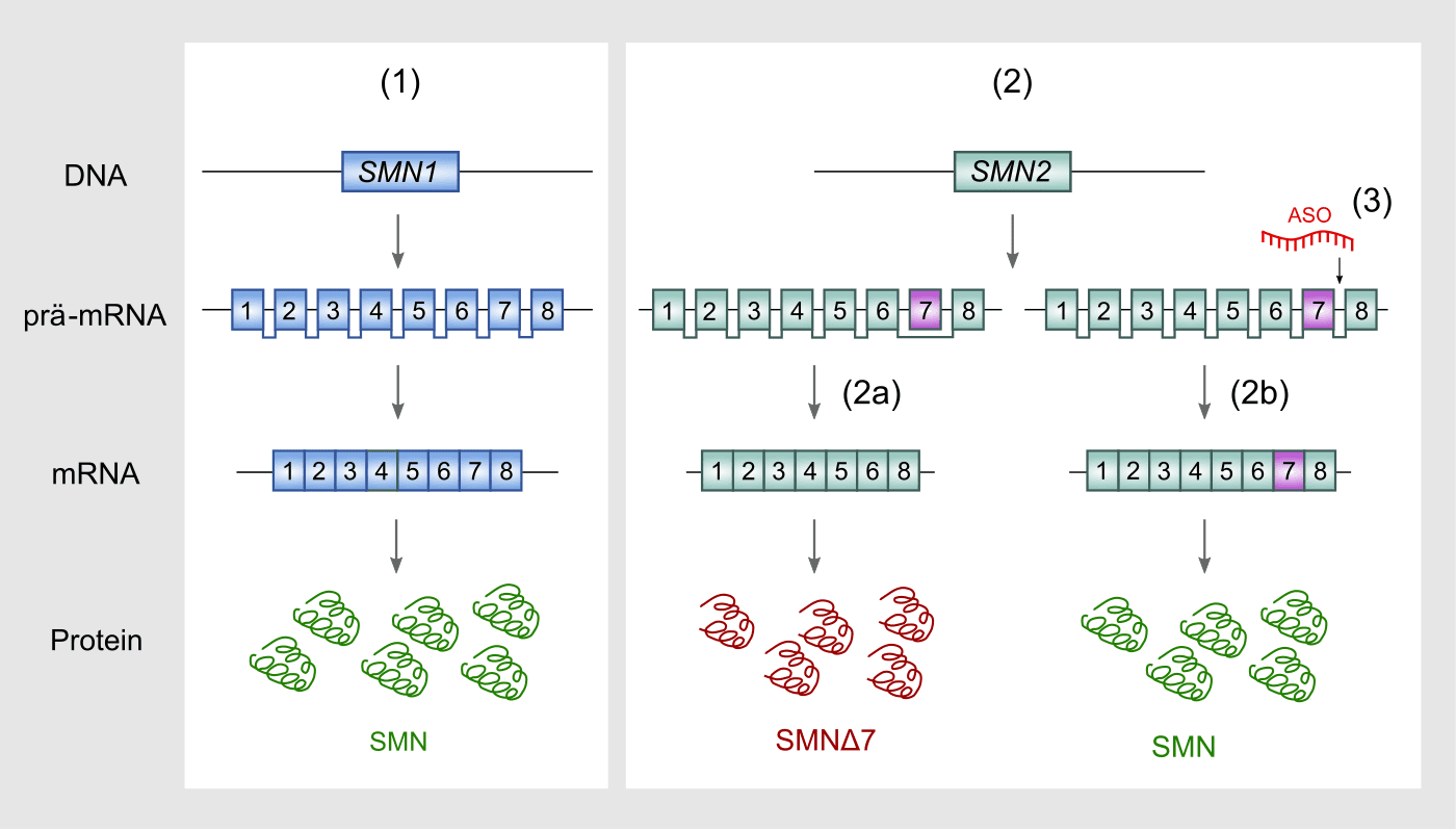 Diagrama do processamento do RNA do gene SMN2 com e sem o oligonucleotídeo antisenso.