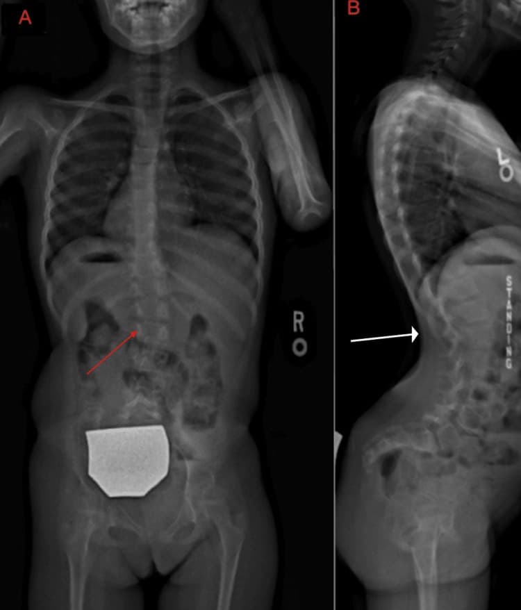 Radiografias da coluna em incidência frontal mostrando curva escoliótica acentuada.