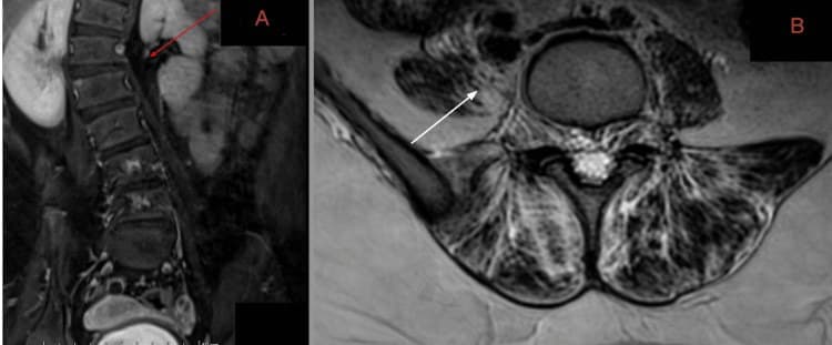 Ressonância magnética coronal da coluna mostrando deformidade toracolombar.