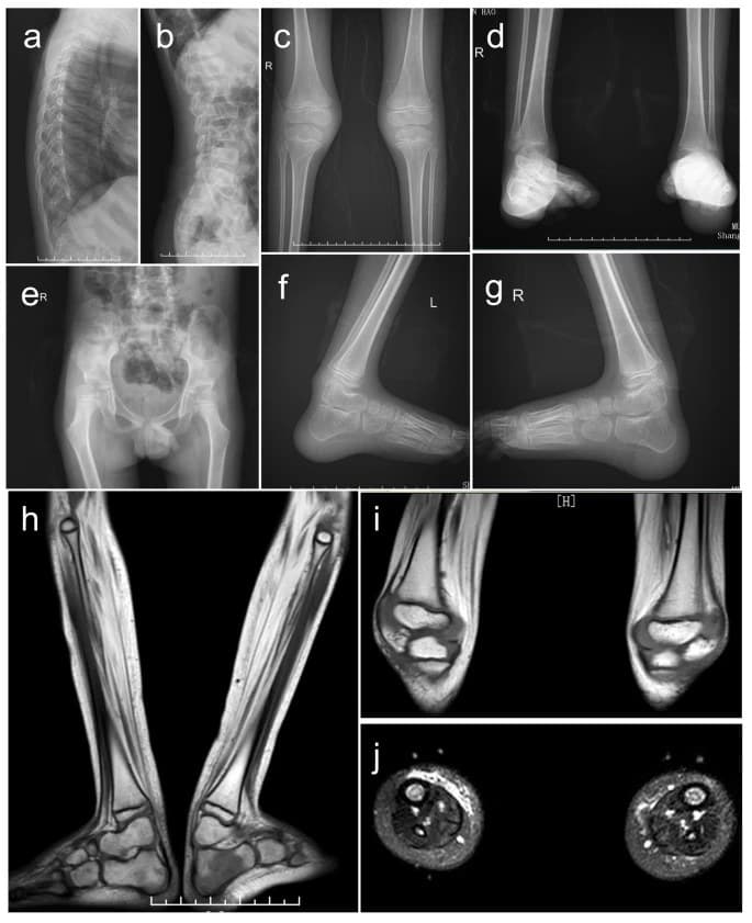 Radiografias e cortes de ressonância magnética das pernas mostrando substituição de músculo por gordura.