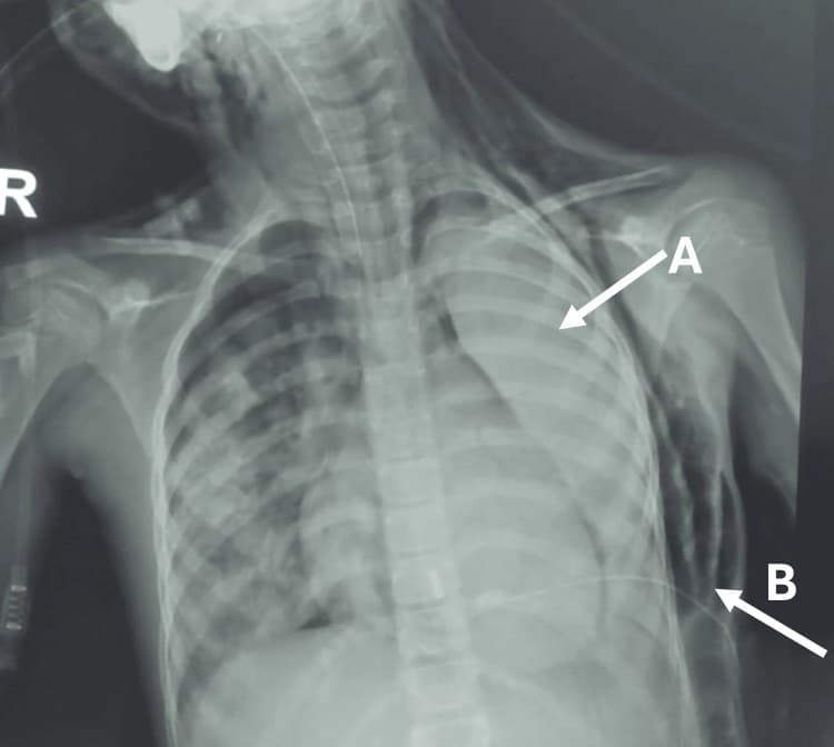 Radiografia de tórax com opacidade pulmonar extensa em paciente com doença falciforme.