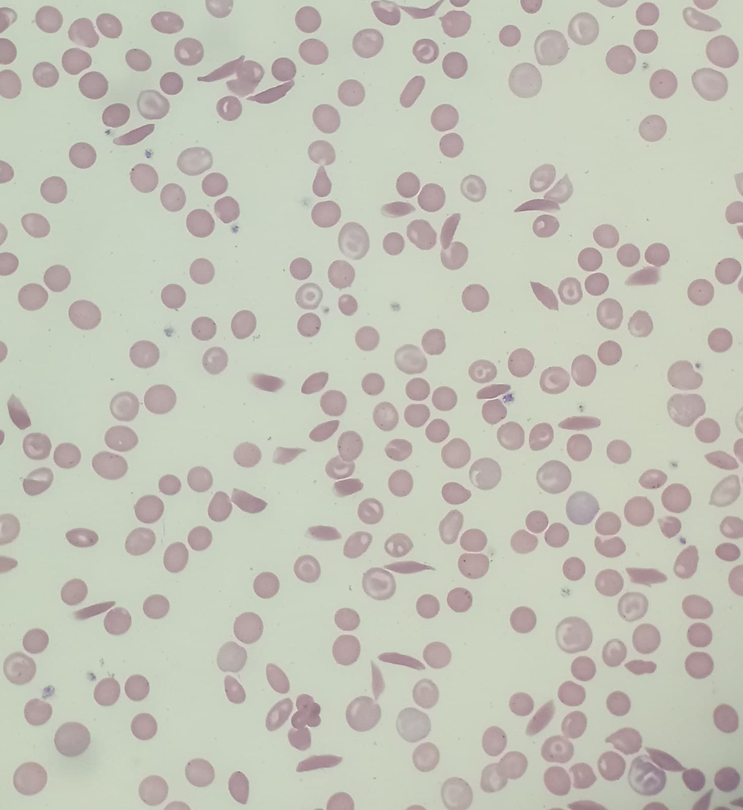 Esfregaço de sangue com hemácias em forma de foice entre hemácias de formato normal.