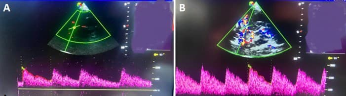 Traçado espectral de doppler transcraniano com a curva de velocidade do fluxo cerebral.