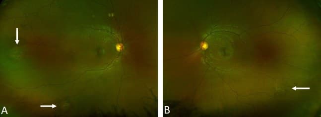 Fotografias de fundo de olho direito e esquerdo com lesões pigmentadas na periferia da retina.