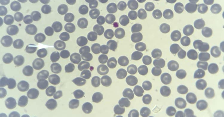Esfregaço de sangue periférico com hemácias em alvo.