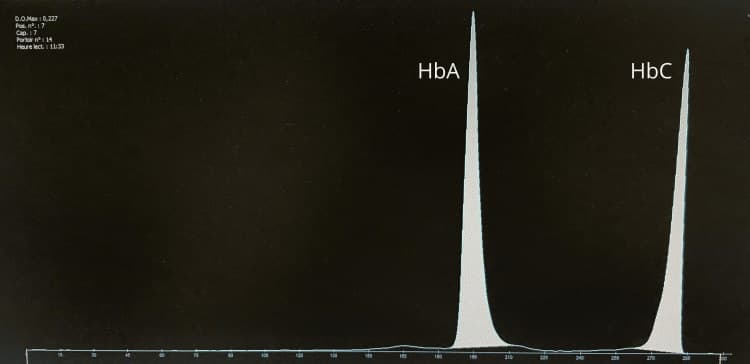 Gráfico de eletroforese capilar com os picos das frações de hemoglobina.