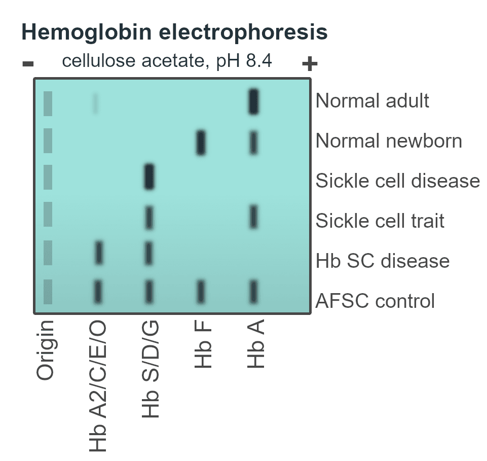 Diagrama das faixas de migração das hemoglobinas na eletroforese em meio alcalino.