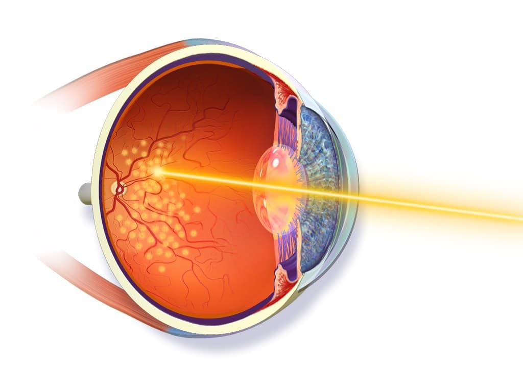 Ilustração de procedimento de fotocoagulação a laser aplicado à retina.