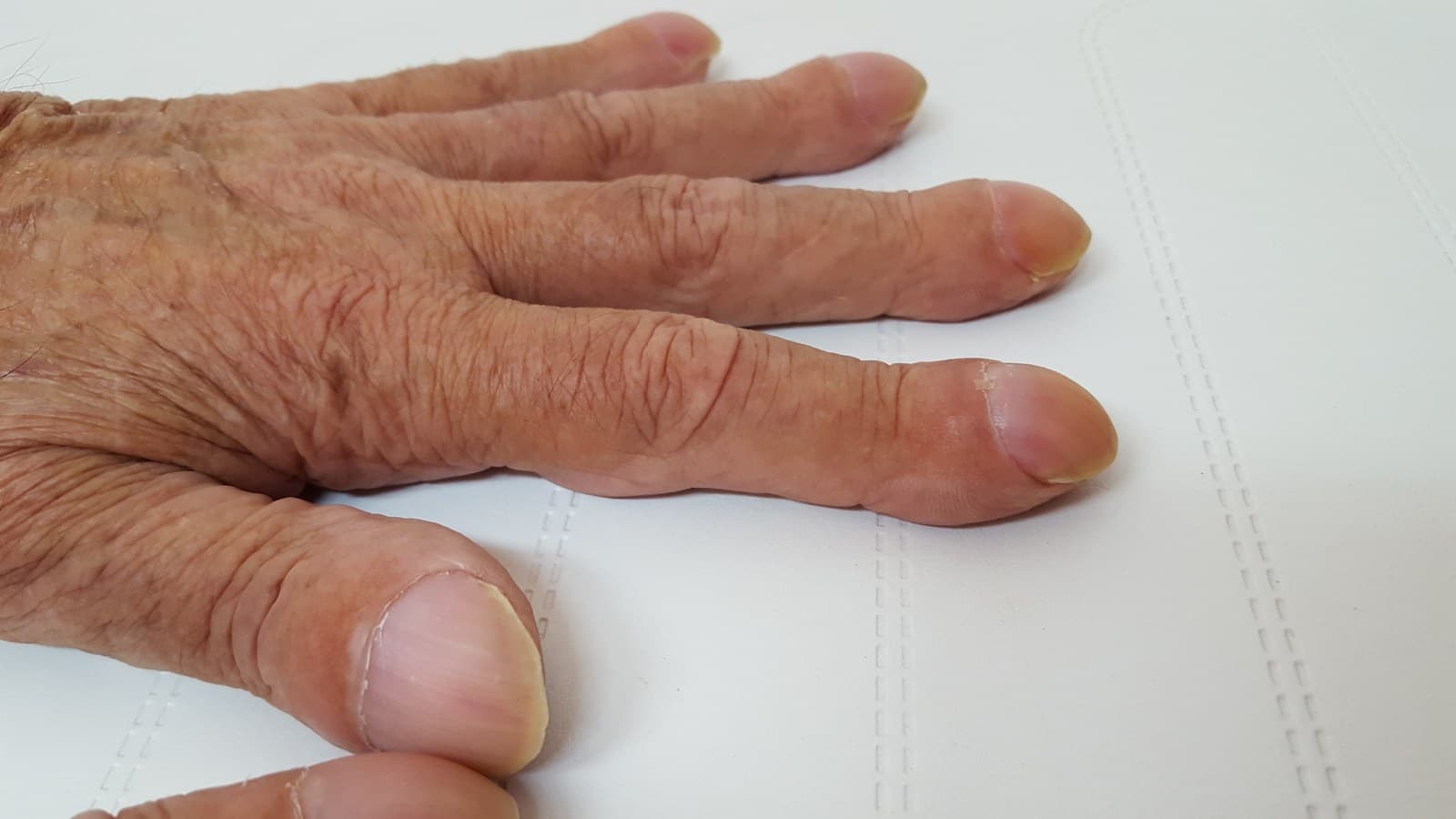 Mãos com dedos de extremidades alargadas e unhas convexas.