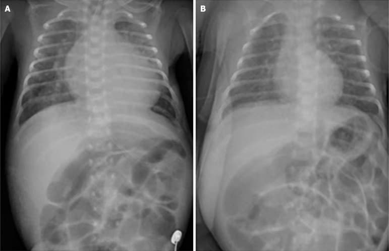 Duas radiografias de tórax lado a lado mostrando redução da área cardíaca após tratamento.
