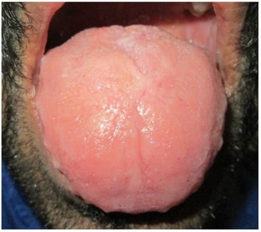 Língua aumentada de volume com marcas dentárias ao longo das bordas.