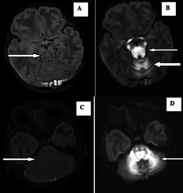 Ressonância magnética axial mostrando alteração de sinal dorsal no tronco encefálico e na substância branca do cerebelo.