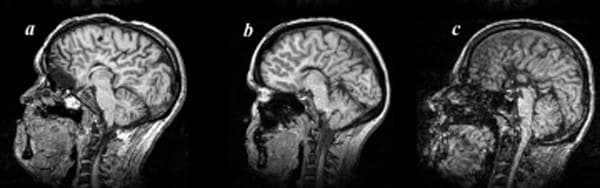Ressonância magnética sagital do encéfalo com ausência do corpo caloso.