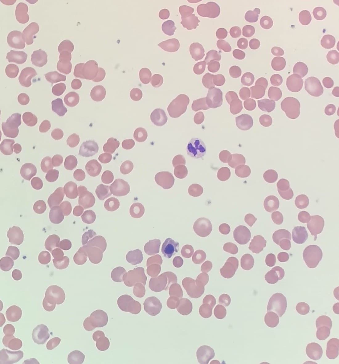 Esfregaço de sangue com hemácias esféricas e densas ao lado de hemácias jovens.