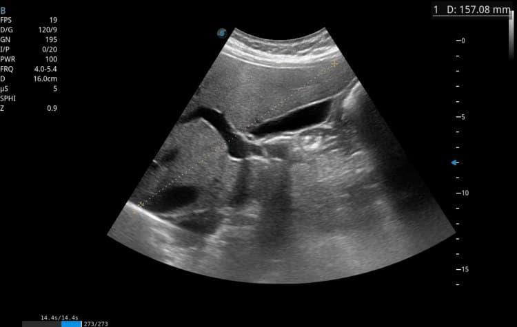 Imagem de ultrassonografia abdominal com o baço aumentado e sua medida.