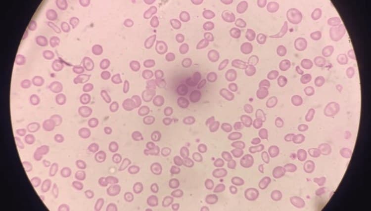 Esfregaço de sangue com hemácias pequenas, pálidas e de formatos variados.
