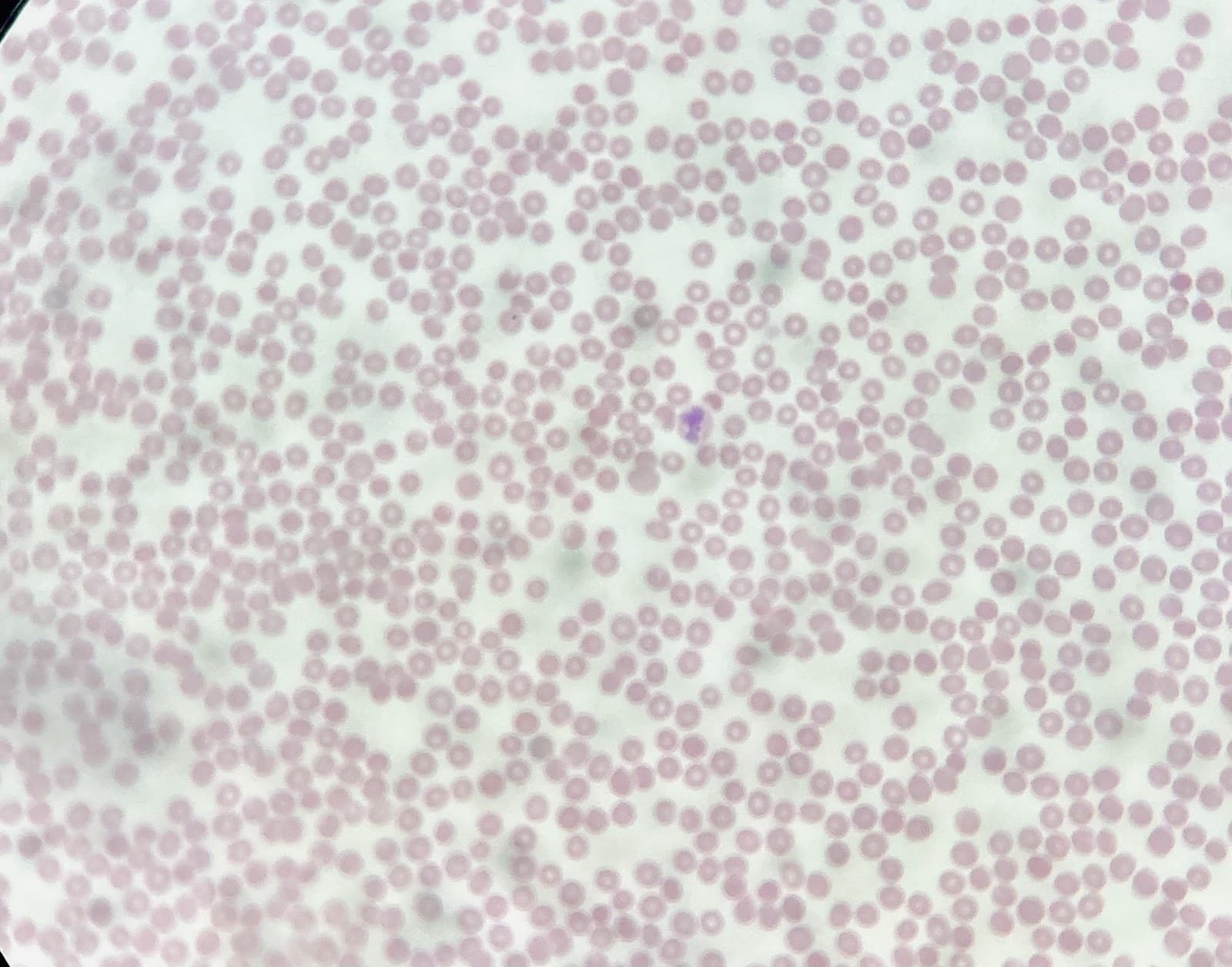 Esfregaço de sangue periférico com escassez de neutrófilos entre as hemácias.