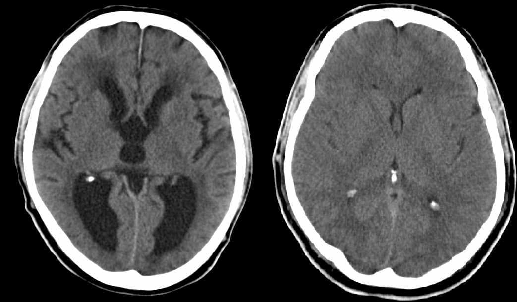 Duas tomografias de crânio lado a lado, uma com ventrículos muito dilatados e outra normal.