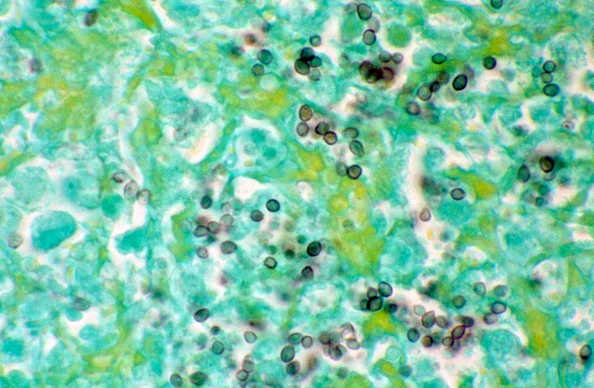 A lung slide seen under the microscope, silver-stained, with a blue-green background and dozens of small dark oval yeasts spread through the necrotic tissue.