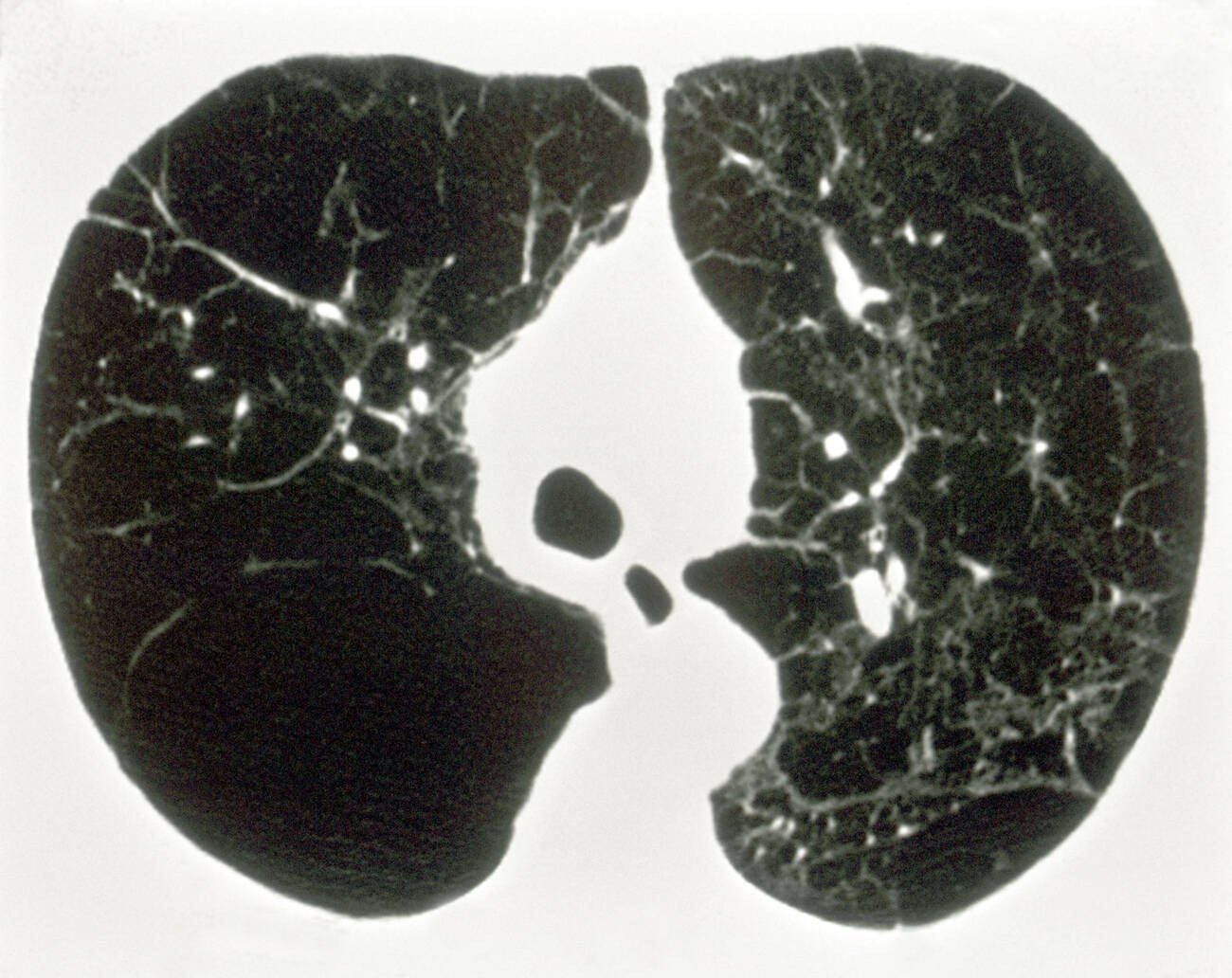 A black-and-white chest CT slice showing both lungs, with broad dark areas and thin white lines of vessels and septa.