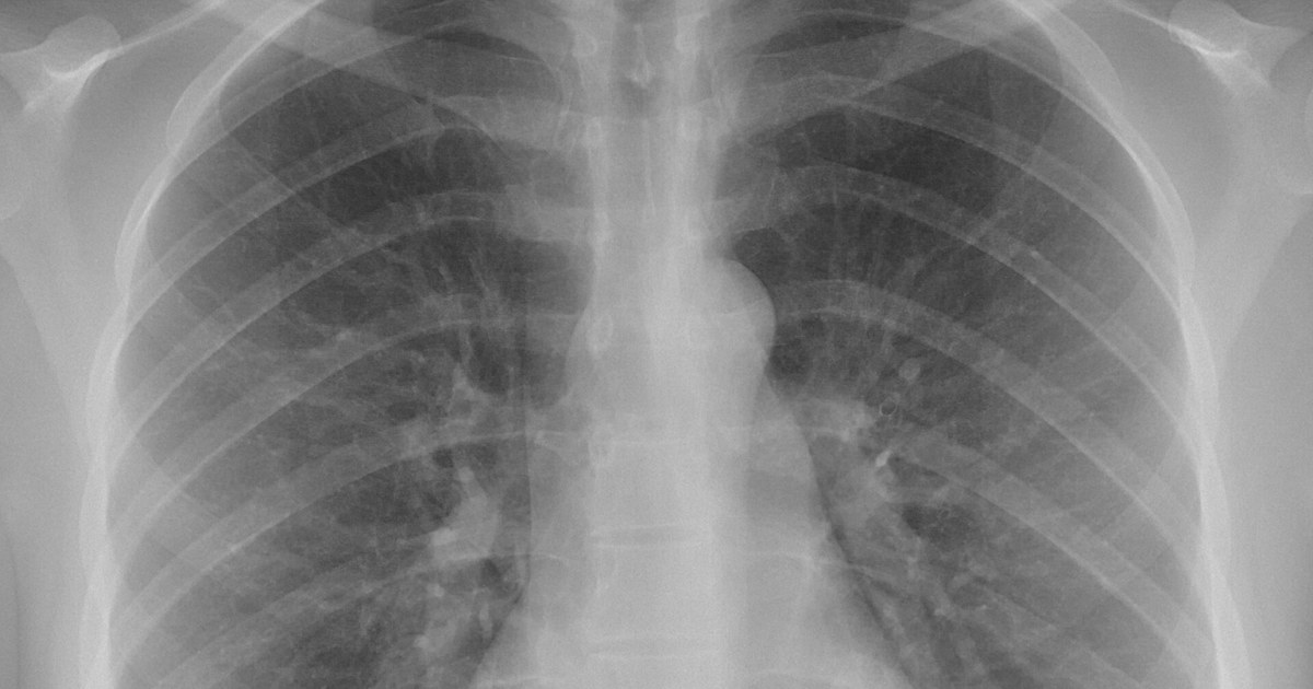 Radiografia de tórax em incidência posteroanterior com campos pulmonares limpos