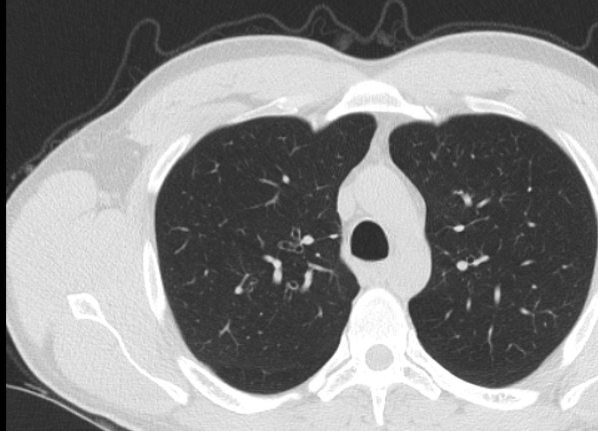 Corte axial de tomografia de tórax em janela de pulmão, com parênquima e vasos pulmonares bem definidos