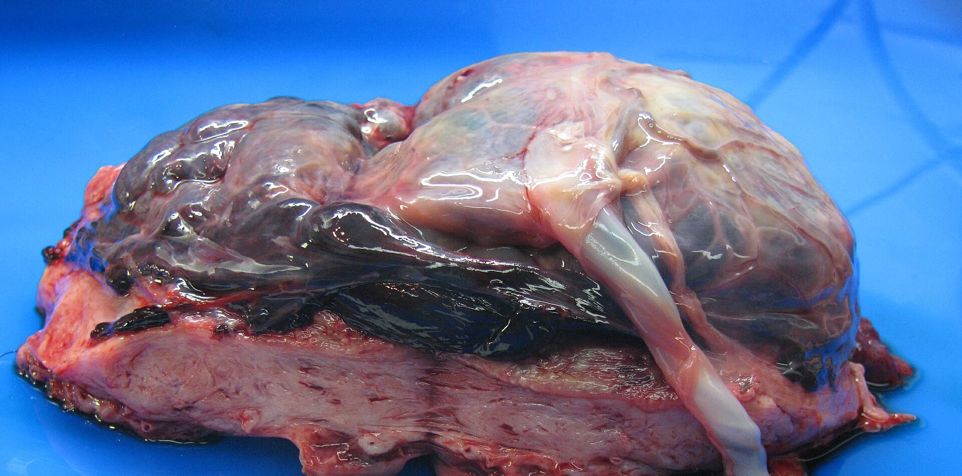 Pieza de patología con placenta y útero sobre fondo azul, que muestra la cara fetal de la placenta, el cordón umbilical y un coágulo oscuro entre la placenta y la pared uterina