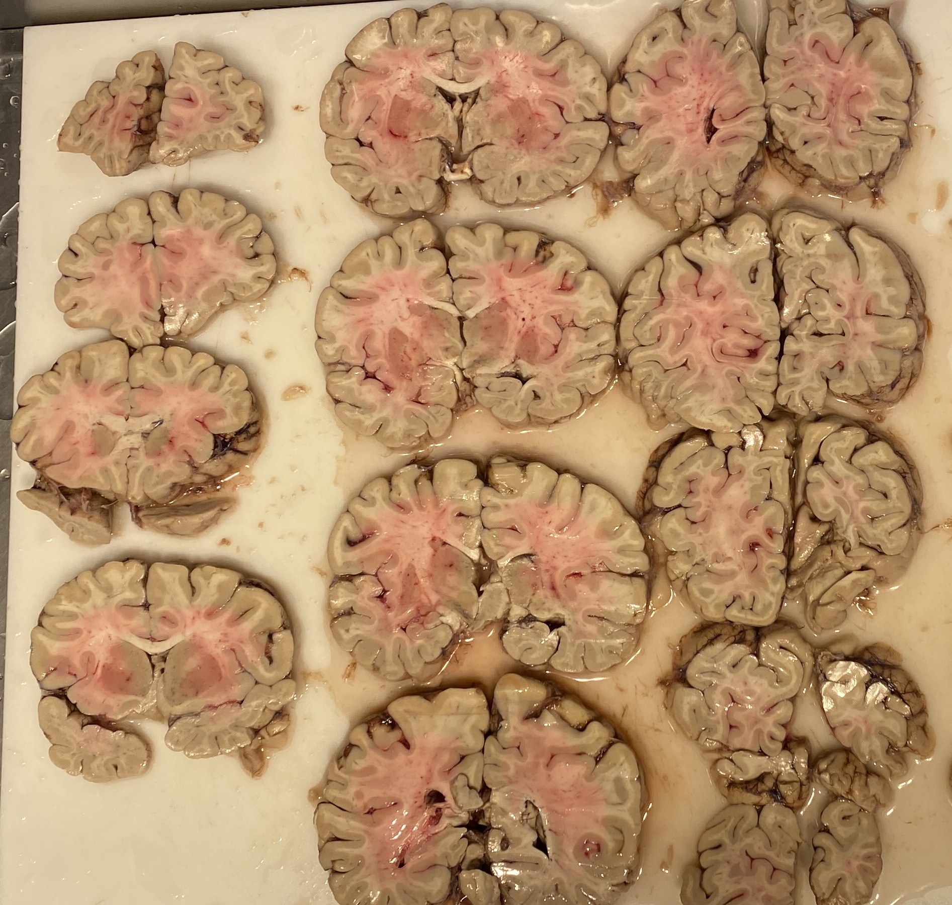 Cortes coronales de cerebro en pieza de patología dispuestos en filas sobre una tabla blanca