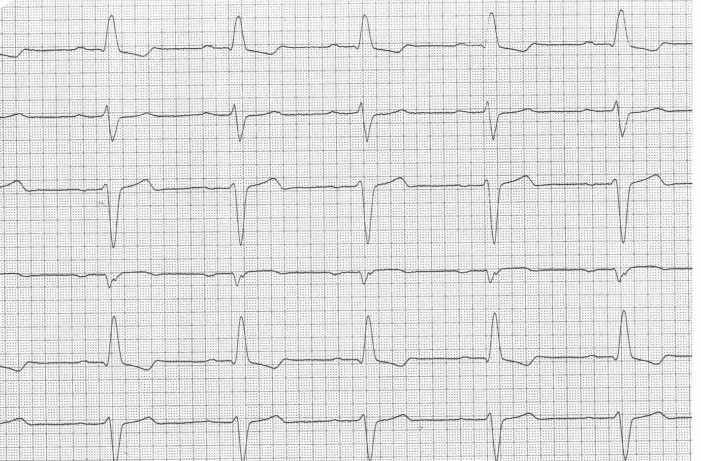 EKG-Kurve auf Millimeterpapier mit mehreren Ableitungen und regelmäßigen QRS-Komplexen, ohne Beschriftung