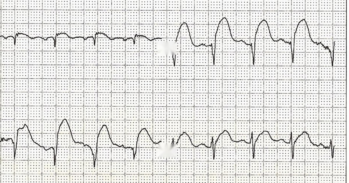 Traçado de ECG de 12 derivações com supradesnivelamento do segmento ST nas derivações precordiais