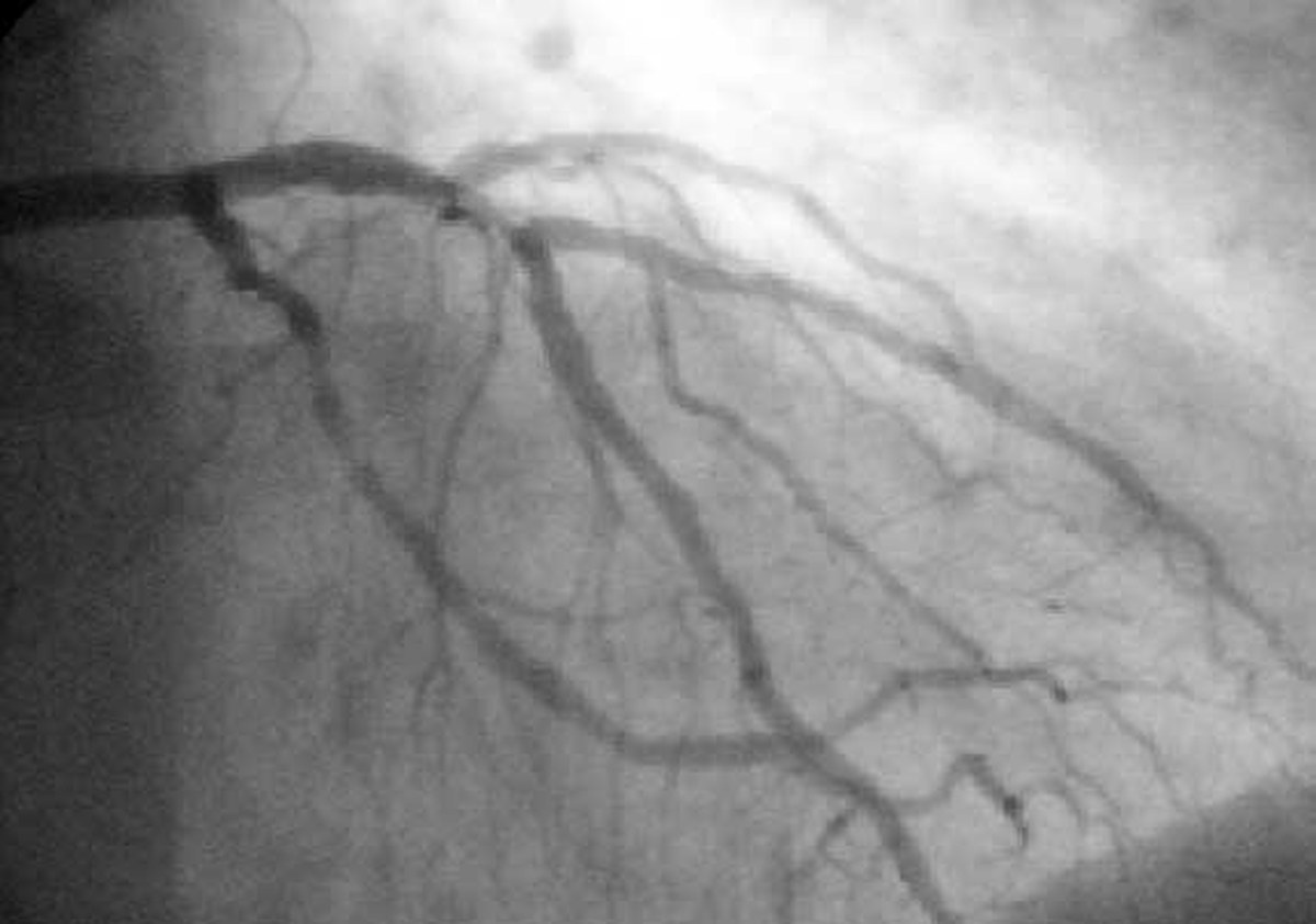 Angiografia coronária em tons de cinza mostrando as artérias do coração preenchidas por contraste