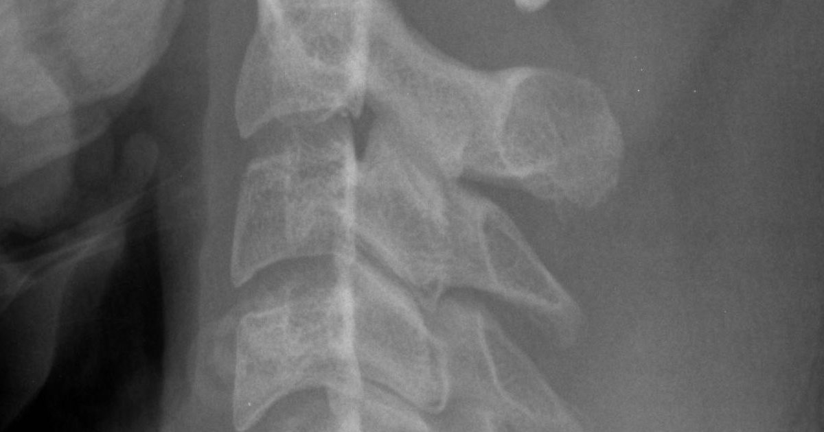 Radiografia lateral da coluna cervical mostrando os corpos vertebrais e os processos espinhosos