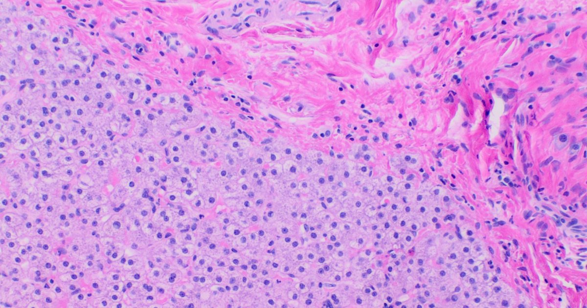 Pink and purple stained histological section of liver, with hepatocytes next to bands of fibrous tissue