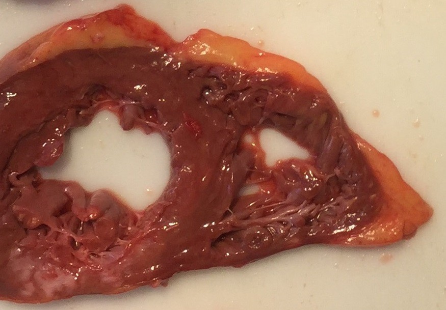 Corte transversal de coração em peça de patologia, mostrando a parede dos ventrículos e uma área mais clara de cicatriz de infarto antigo