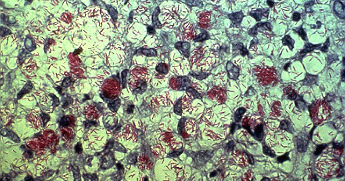 Microscopia de tecido com bacilos álcool-ácido resistentes corados em vermelho pela técnica de Ziehl-Neelsen