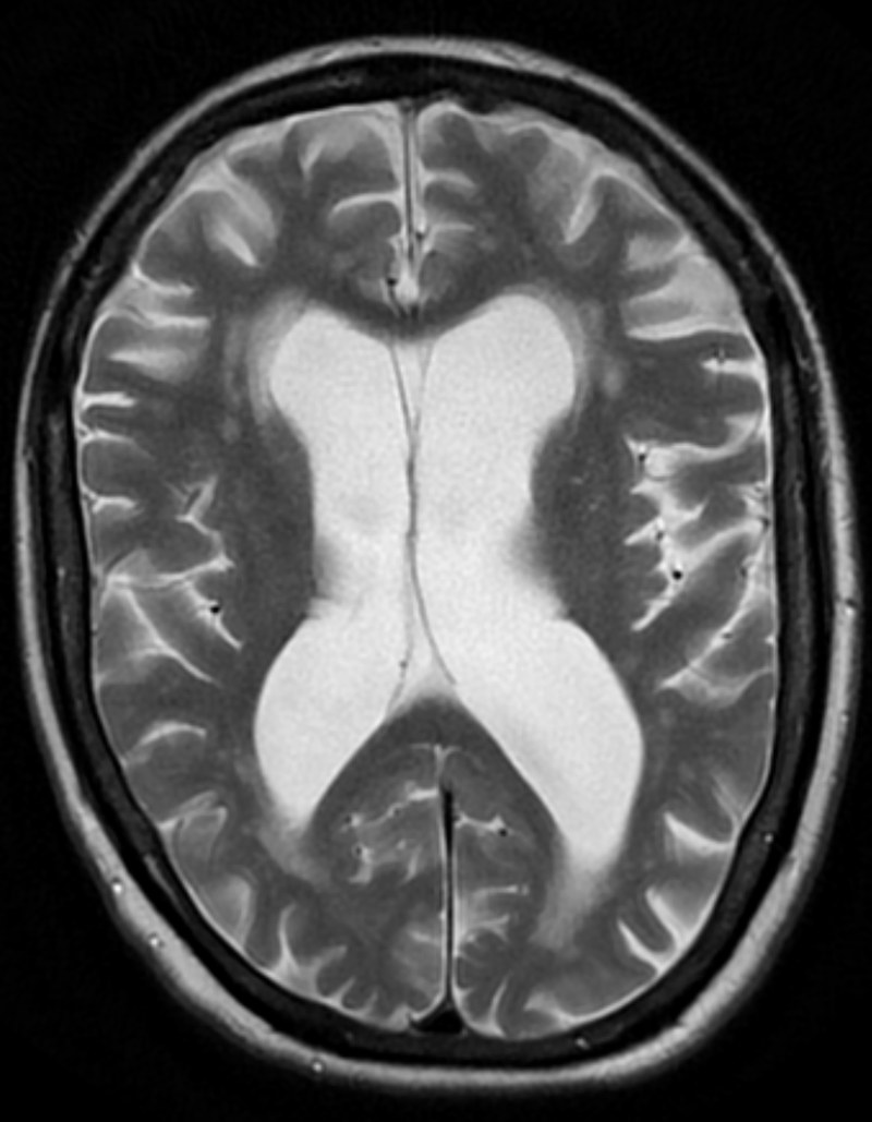 Ressonância magnética axial do encéfalo com ventrículos alargados e sulcos amplos, compatível com atrofia cerebral