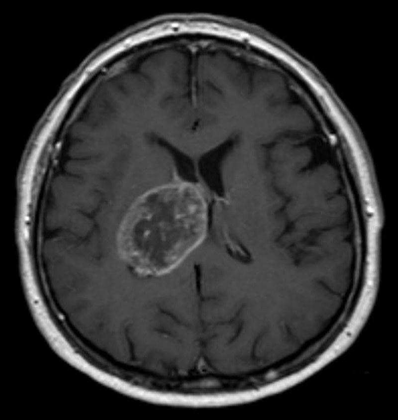 Ressonância magnética axial com contraste mostrando lesão cerebral com realce periférico, compatível com glioblastoma