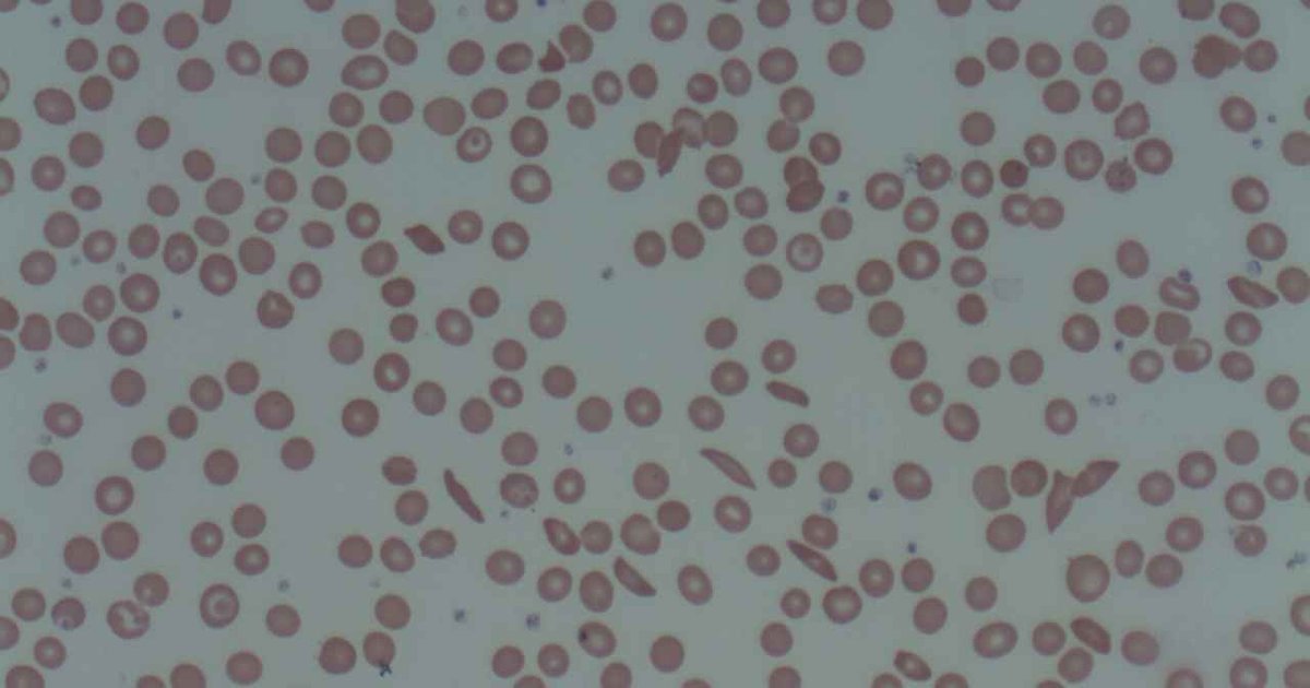 Esfregaço de sangue ao microscópio com hemácias redondas e algumas em forma de foice