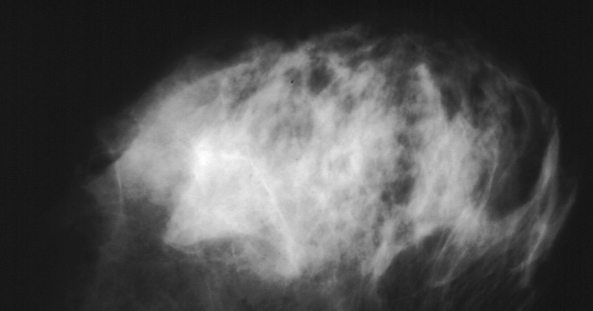 Mamografia em preto e branco mostrando o tecido mamário denso com áreas claras e escuras sobre fundo preto