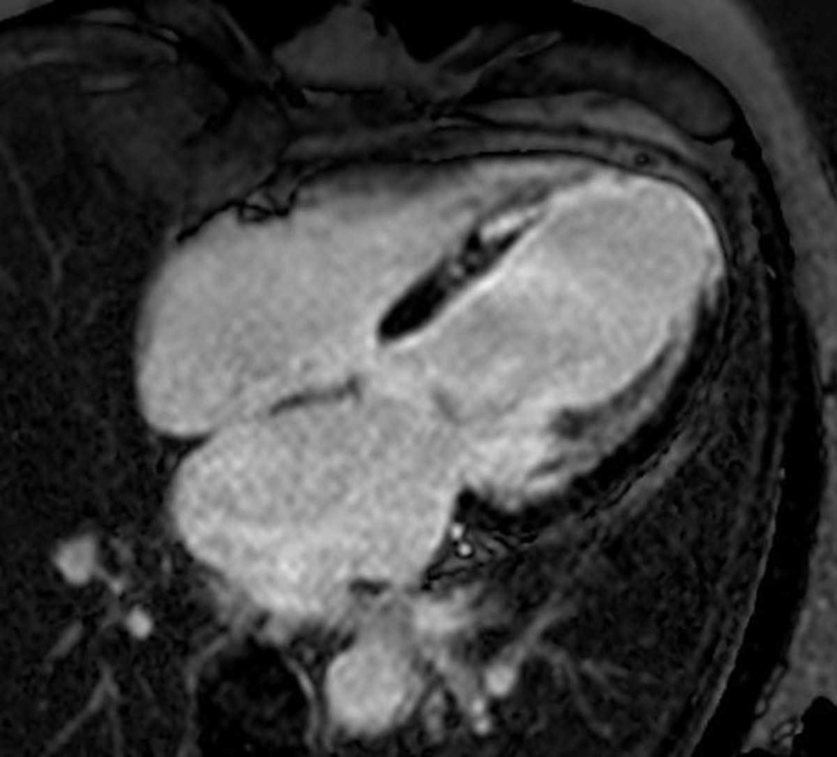 Ressonância magnética cardíaca em corte de quatro câmaras, com realce tardio indicando área de infarto