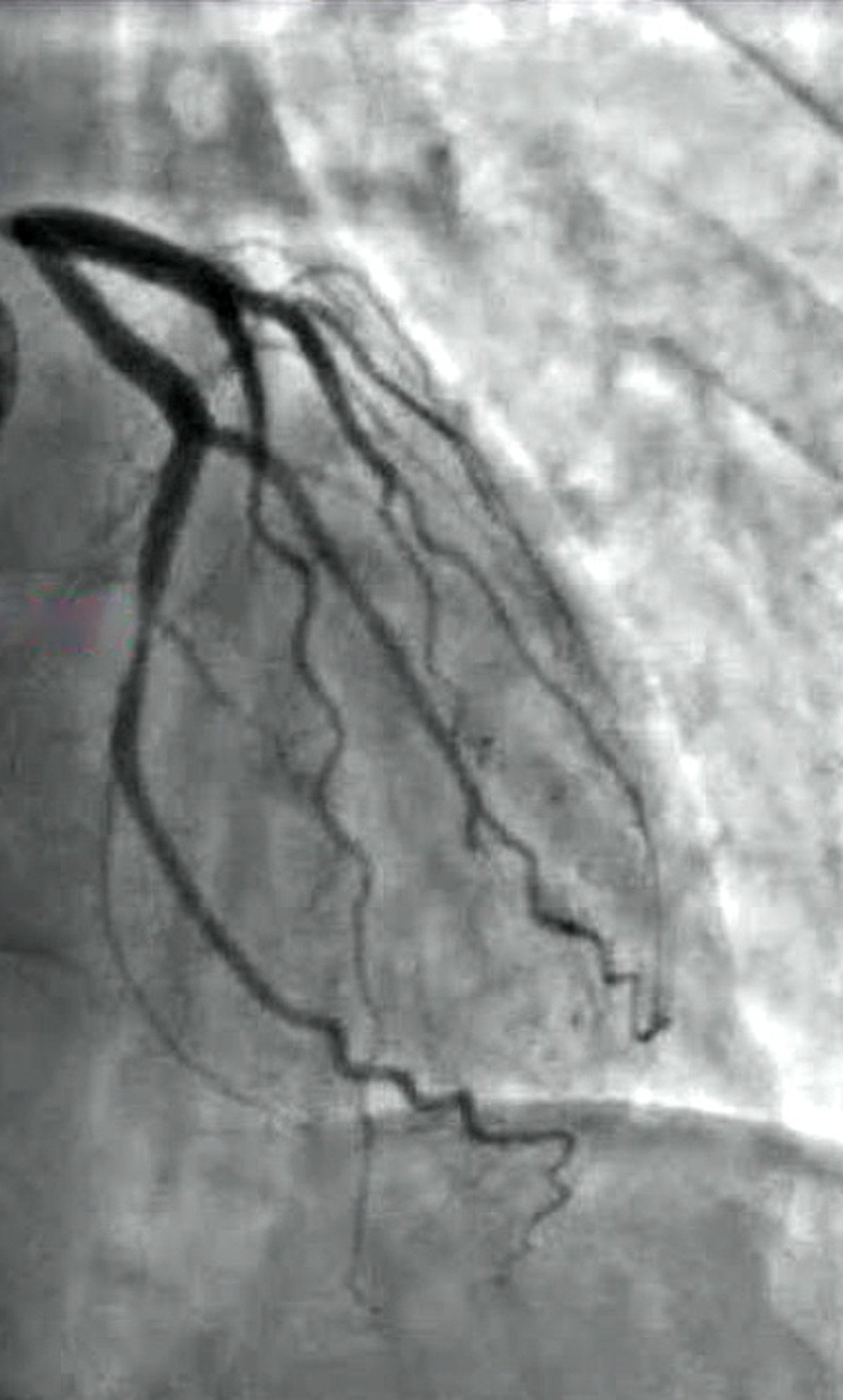 Angiografia coronária em tons de cinza com estreitamento localizado em uma artéria do coração