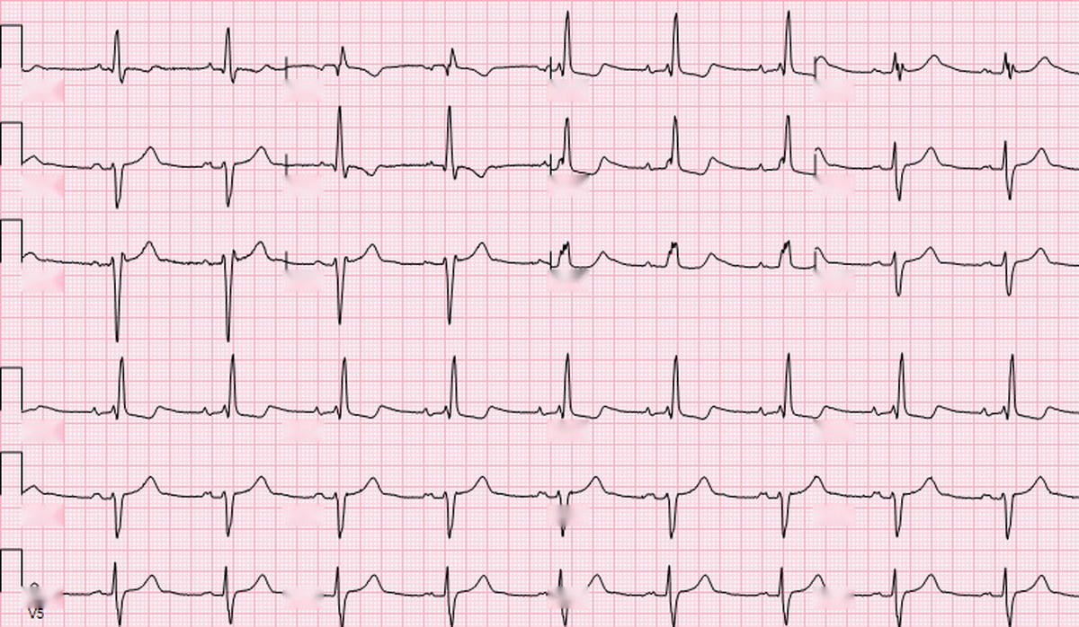 Traçado de ECG de 12 derivações com padrão de bloqueio bifascicular, com QRS alargado