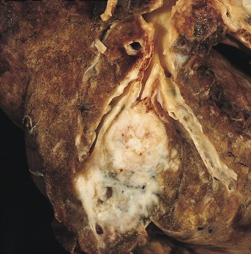 Corte de pulmão de autópsia com tumor esbranquiçado envolvendo um brônquio subsegmentar e parênquima escurecido ao redor