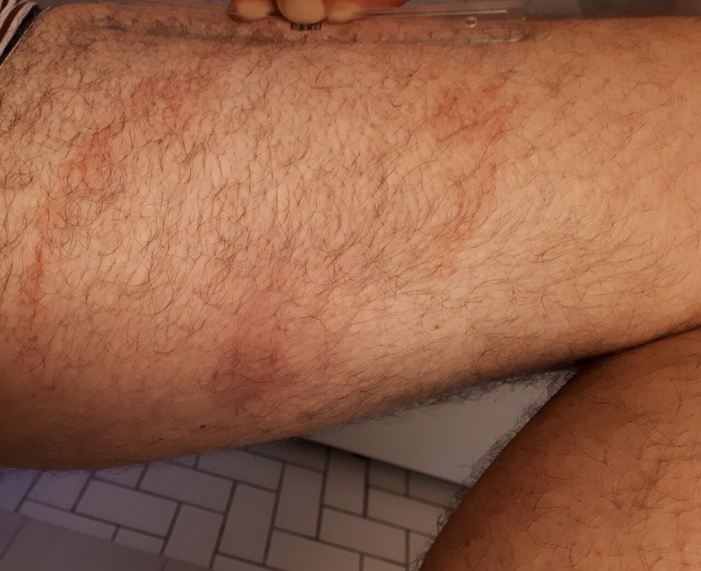 Mancha avermelhada ampla e irregular na pele da coxa, sem rosto visível